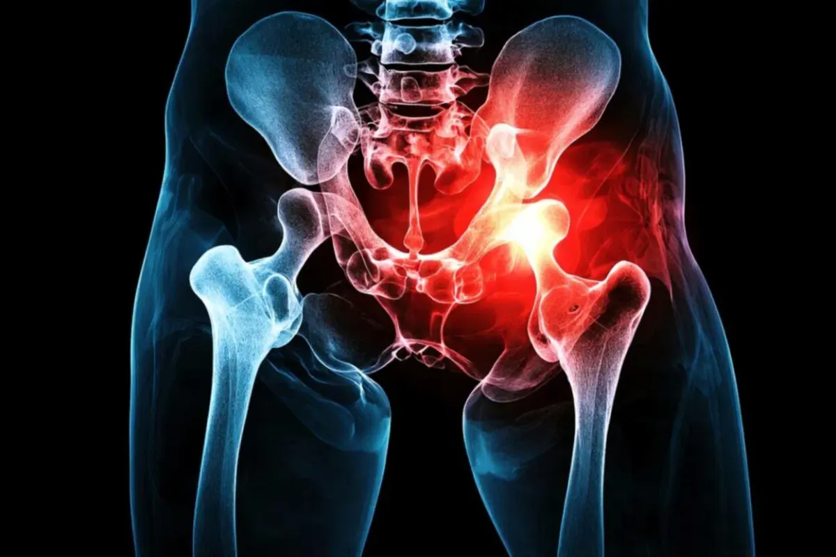 Hip Replacement Surgery