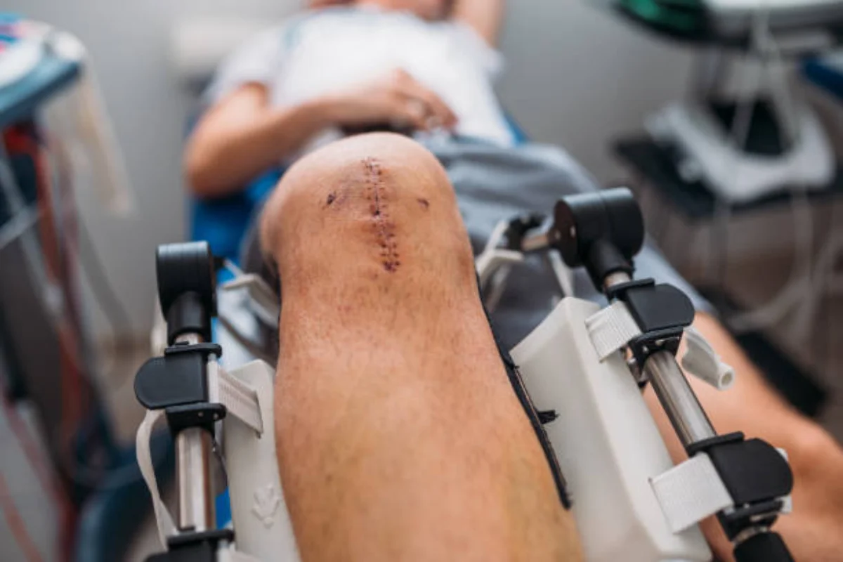 Knee Replacement Surgery